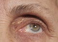 Senior Eye and Wrinkles