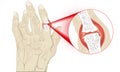 Senior Hand Suffering from Rheumatoid Arthritis illustration