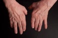 Senior hands. Suffering from pain and rheumatism