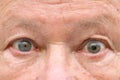 Senior man with anisocoria showing unequal dilation of his pupil