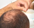 Senior man and hair loss issue Royalty Free Stock Photo