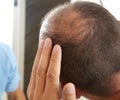 Senior man and hair loss issue Royalty Free Stock Photo