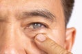 Senior man has cataract. Cataracts are common in older people Royalty Free Stock Photo