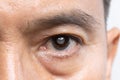 Senior man has cataracts. Generally, cataracts are common in older people