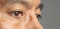 Senior man has cataracts. Generally, cataracts are common in older people