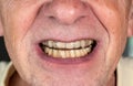 Senior man putting a night guard onto crooked teeth