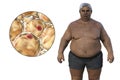 A senior overweight man with a close-up view of adipocytes, 3D illustration highlighting the role of these fat cells in Royalty Free Stock Photo
