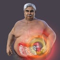 A senior overweight man with the presence of large intestine spasms associated with irritable bowel syndrome, 3D