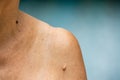 Senior woman have Brown mole on brachium, Black mole on neck, Medicine, Asian Body skin part, Healthcare Royalty Free Stock Photo