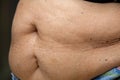 Senior women body fat belly front view, Sterilization scar, Bla