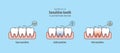 Sensitive teeth illustration vector on blue background. Dental c Royalty Free Stock Photo