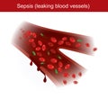 Sepsis. When the body has immune response to bacterial infections, causing inflammation and leaking blood vessels in the body