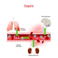 Sepsis. Close-up of cross section of blood vessel with Bacterial infection. Royalty Free Stock Photo