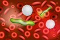 Sepsis is an inflammatory immune response triggered by an infection. Royalty Free Stock Photo