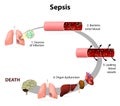 Sepsis Royalty Free Stock Photo