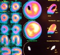 Septal wall ischemia nuclear stress test