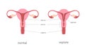 Septate and normal human uterus structure. Uterine septum as a congenital uterine malformation. Anatomy chart.