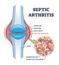 Septic arthritis joint inflammation with medical explanation outline diagram