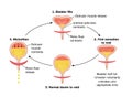 Sequence of events in voiding the bladder Royalty Free Stock Photo