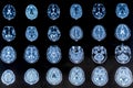 Series of CAT Scans showing the human head. Examination, treatment. Tamography, MRI, Royalty Free Stock Photo