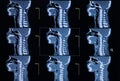 Series of images from a computerized tomography of neck (cervical bone) Royalty Free Stock Photo