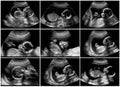 Series of 9 ultrasound of 20 weeks fetus Royalty Free Stock Photo