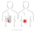 Serratus posterior Inferior trigger point and lower back pain