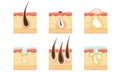 Set of skin images with hair roots, acne and sweat. Vector illustration.