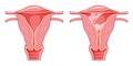 Set of Asherman syndrome Female reproductive system scar tissue adhesions in uterus Front view in a cut. Sick and normal