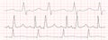 Set of black heartbeat diagrams on red graph paper. ECG electrocardiogram chart. Cardiac rhythm line. Cardio test signs