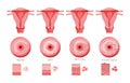 Set of Cervical invasive cancer intraepithelial neoplasia Dysplasia 1 2,3 and normal stage cell morphology on pap smear