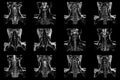 Set of coronal MRI scans of neck area of caucasian male with bilateral paramedial extrusion of the C6-C7 segment with