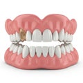 Close up of a set of dentures with one decayed tooth isolated on white background Royalty Free Stock Photo