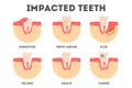 Set of diffrent impacts on human teeth. Dental and oral diseases.