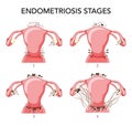 Set of Endometriosis stages Female reproductive system pain pcos tissue cancer cyst uterus. Front view. Human anatomy