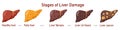 Set of flat vector illustrations on the theme of medicine. Stages of liver diseases.