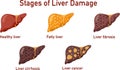 Set of flat vector illustrations on the theme of medicine. Stages of liver diseases.