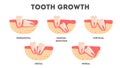 Set of human teeth in diffrent condition. Dental health and disease concept.