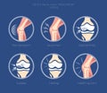 Set of icons of the joints and their treatment Cartilage damage, arthritis, osteoarthritis, restoration of cartilage.