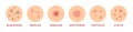 Set of isolated icons types of acne. Pimples and skin close up. Round colored flat realistic style. Problem skin. White background