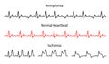 Set Lines heartbeat normal, arrhythmia and ischemia.