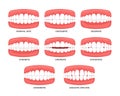 Set of Malocclusion types set with side view of normal, misalignment and incorrect relation between human teeth of upper and lower Royalty Free Stock Photo