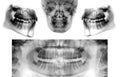 Set of Panoramic dental X-Ray