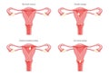 Set of Polyps in the uterus Female reproductive system in cross sections diseases and normal. Front view in a cut. Human