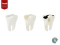 Set of realistic tooth including healthy tooth and decayed tooth Royalty Free Stock Photo