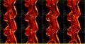 Set of 12 sagittal red colored MRI scans of neck area of caucasian 34 years old male with bilateral paramedial extrusion