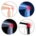 Arthritis in knee joint Royalty Free Stock Photo
