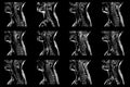 Set of sagittal MRI scans of neck area of caucasian male with bilateral paramedial extrusion of the C6-C7 segment with