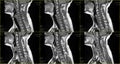 Set of 6 sagittal MRI scans of neck area of caucasian 34 years old male with bilateral paramedial extrusion of the C6-C7