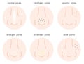 Set of skin pores on human nose, normal pores, sagging pores, open pores, blackhead pores, whitehead pores, acne scar pores. Royalty Free Stock Photo